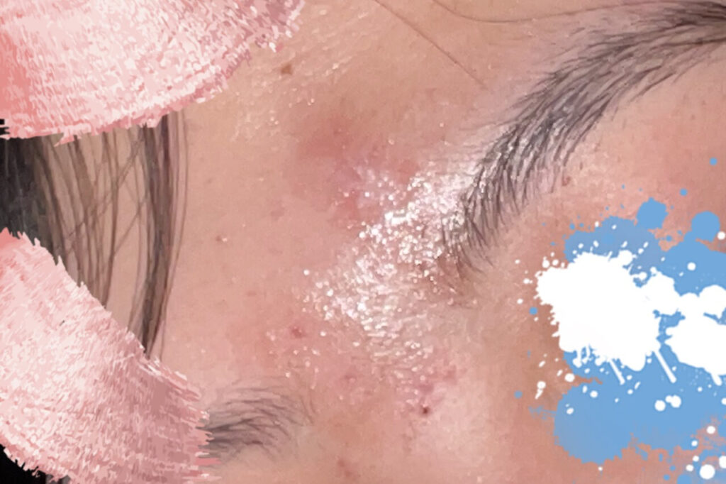 眉間部分の肌荒れ